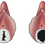 Дівоча пліва молодої дівчини (ліворуч) та жінки, що живе активним статевим життям (праворуч)