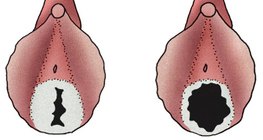 Дівоча пліва молодої дівчини (ліворуч) та жінки, що живе активним статевим життям (праворуч)