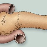 Підшлункова залоза