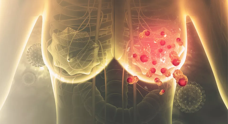 Role of physiotherapy in supporting recovery from breast cancer treatment