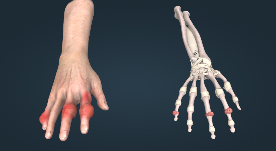Gout
